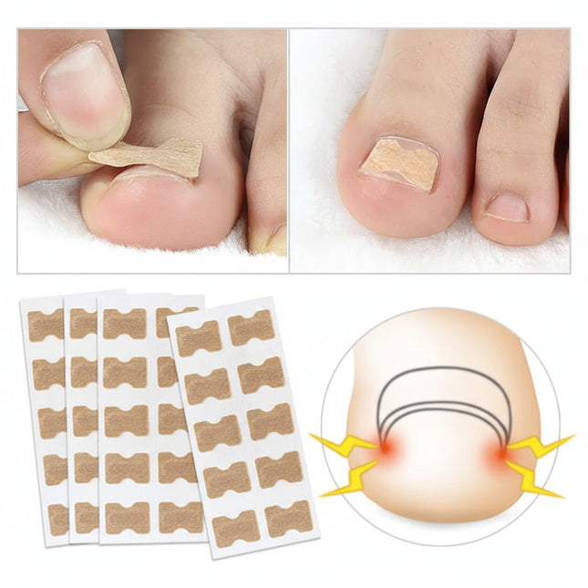 Toe Align Ingrown Nail Corrector Stickers